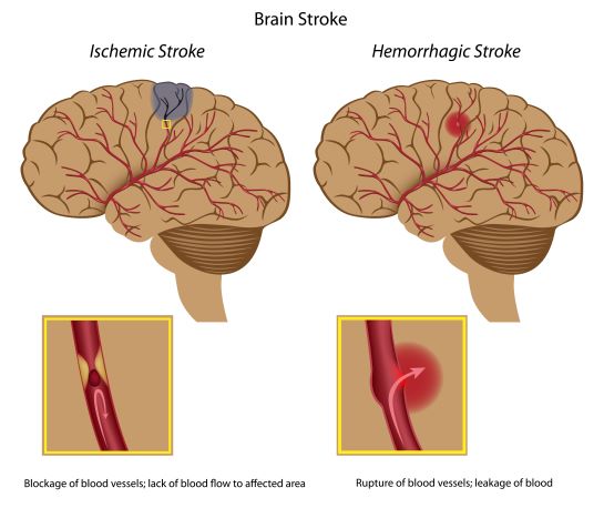 A picture of a side-by-side comparison of a brain displaying the two main types of stroke: ischemic and hemorrhagic strokes