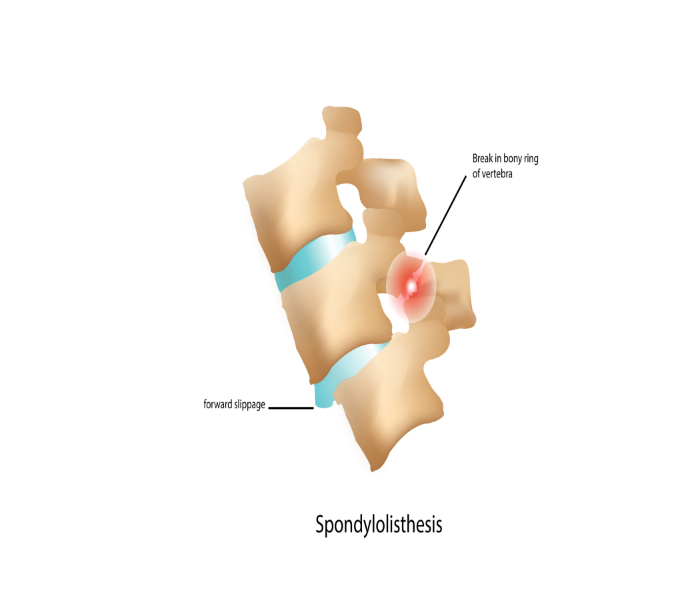 An animated picture of spondylolisthesis and slippage of spinal vertebra.
