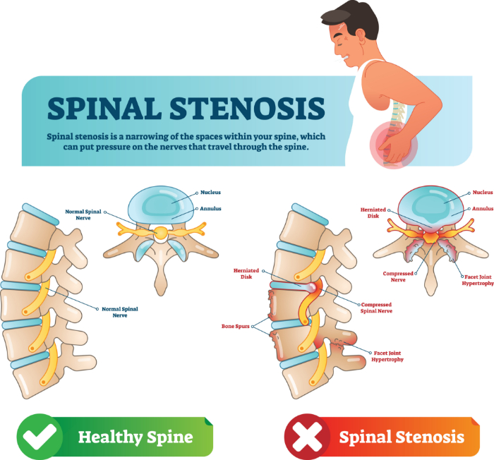 An animated picture of a healthy spine vs. spinal stenosis.
