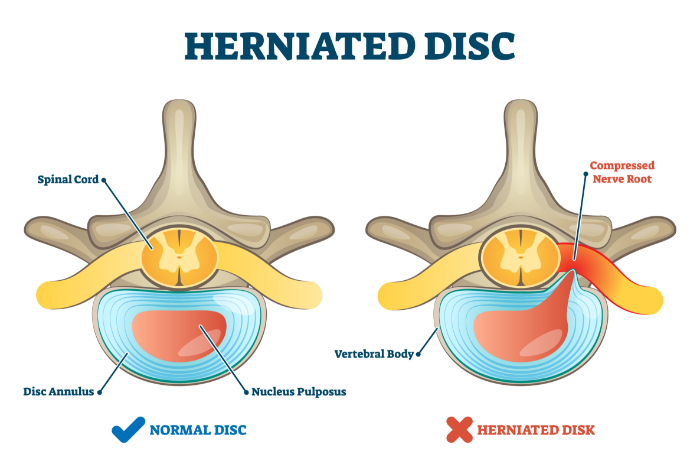 An animated picture of a normal disc and a herniated disc with labels.