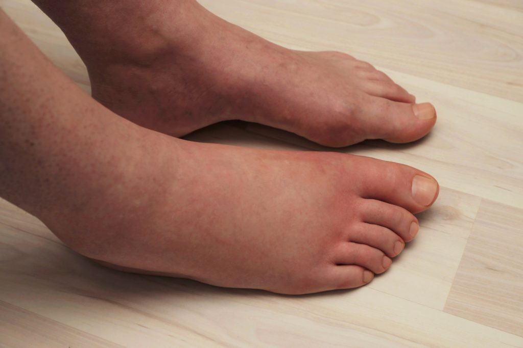 Hispanic man with a swollen right foot