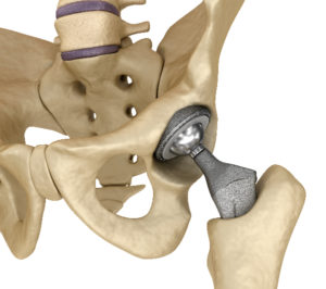 Read more about the article 10 Ways to Protect Your Hip After Surgery or Acute Injury